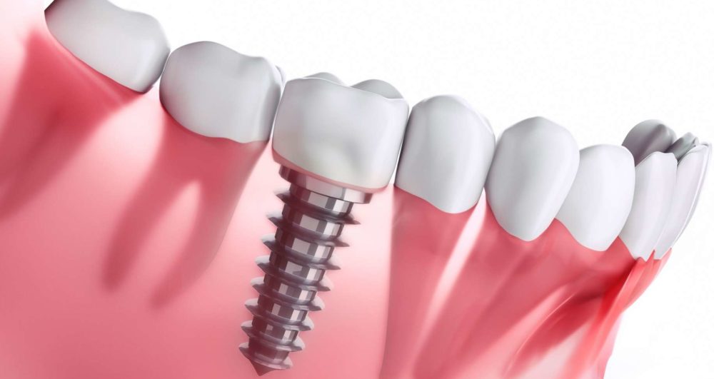 Adilguelzim_implant-dentaire-Implantologie-dentaire